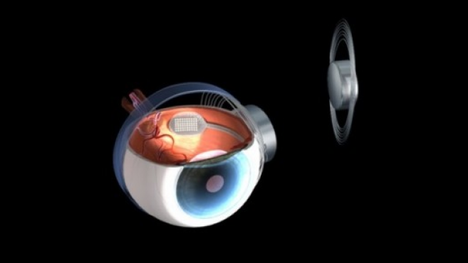 DMLA : Des patients se verront implanter l’œil bionique Argus II