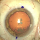 Un collyre pour remplacer la chirurgie de la cataracte 